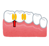 歯と歯の間のイラスト2