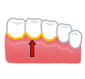 歯と歯ぐきの間のイラスト1