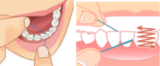 デンタルフロスを使って歯と歯の隙間を清掃する方法のイラスト画像