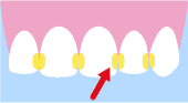 歯と歯の間のイラスト画像