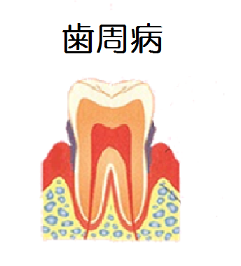 歯周病のイラスト